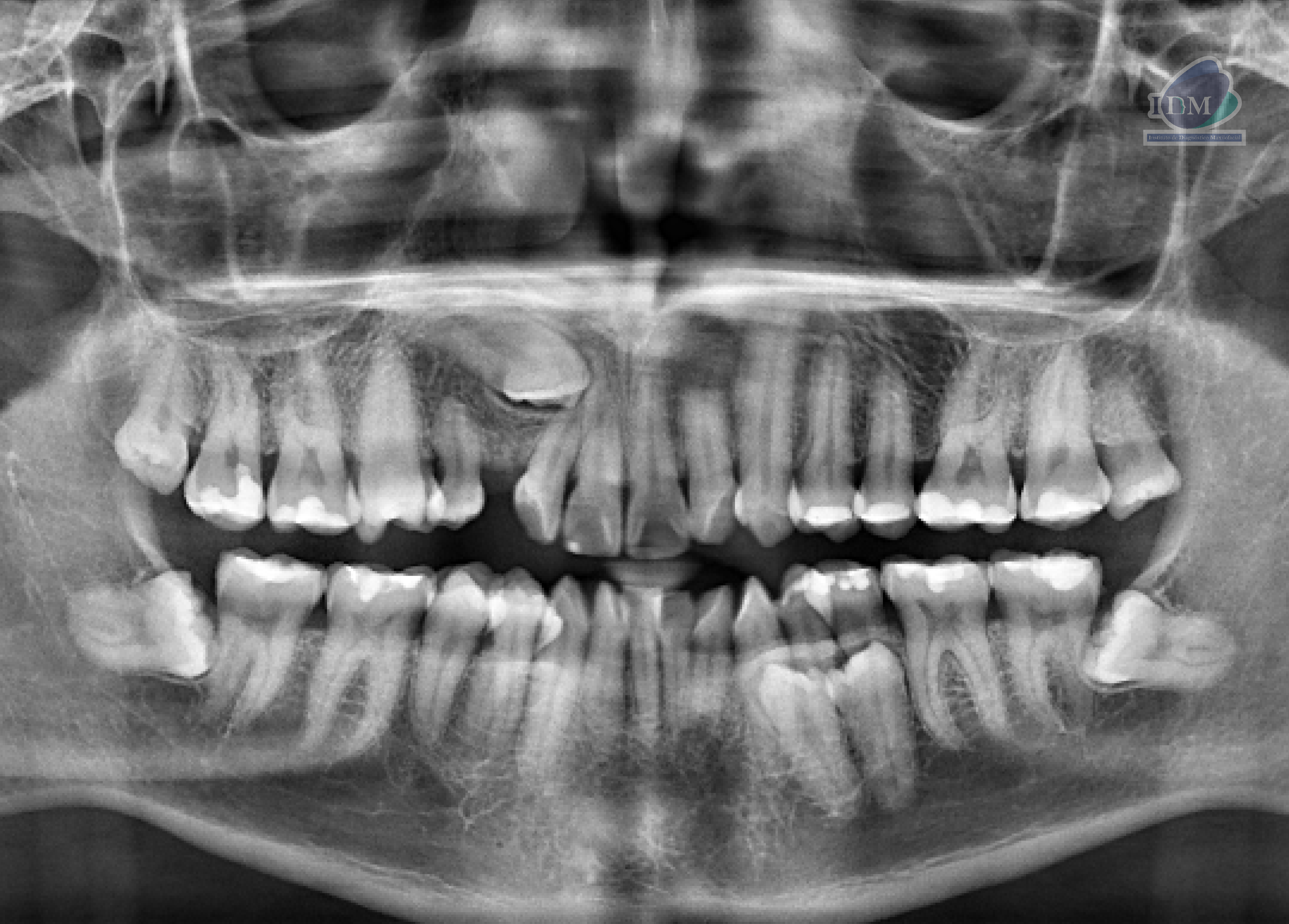 Caso 295 – IDM RADIOGRAFIA PANORAMICA IDM 2