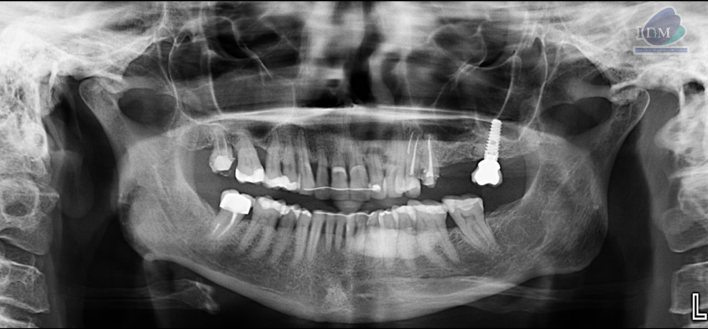 Caso 296 – IDM RADIOGRAFIA PANORAMICA IDM