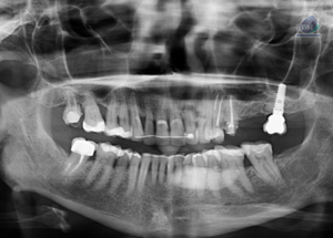 Caso 296 – IDM RADIOGRAFIA PANORAMICA IDM 2