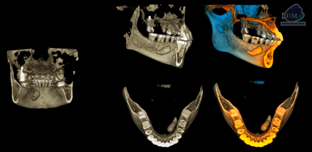 Caso 296 – IDM RECONSTRUCCION 3D - IDM