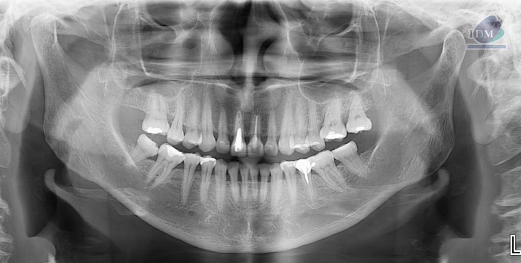Caso 297 – IDM RADIOGRAFIA PANORAMICA IDM