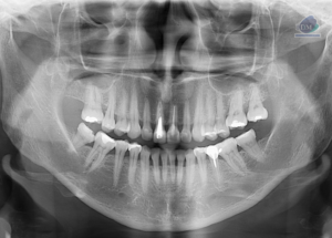 Caso 297 – IDM RADIOGRAFIA PANORAMICA IDM 2