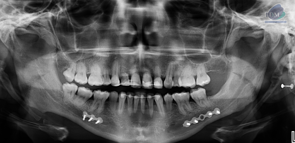 Caso 298 – IDM RADIOGRAFIA PANORAMICA IDM