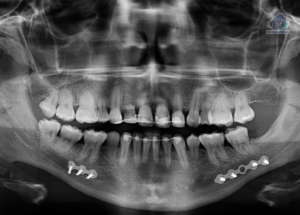 Caso 298 – IDM RADIOGRAFIA PANORAMICA IDM 2