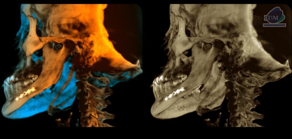 Caso 298 – IDM RECONSTRUCCION 3D 2 - IDM