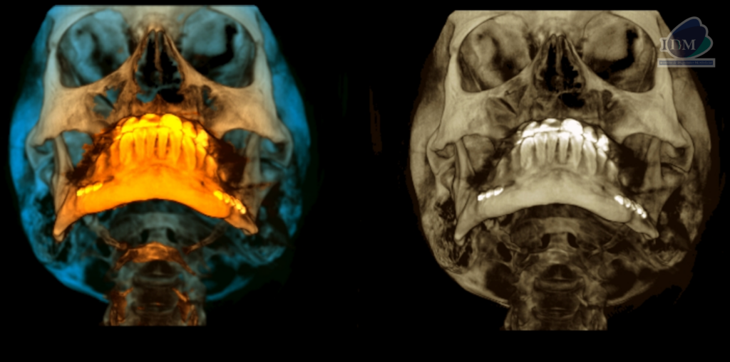 Caso 298 – IDM RECONSTRUCCION 3D 3 - IDM