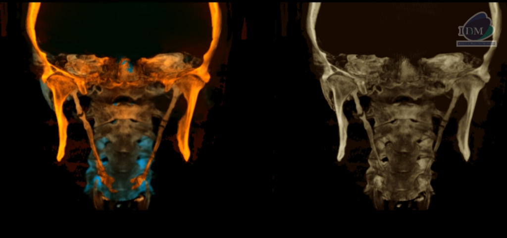 Caso 298 – IDM RECONSTRUCCION 3D 4 - IDM