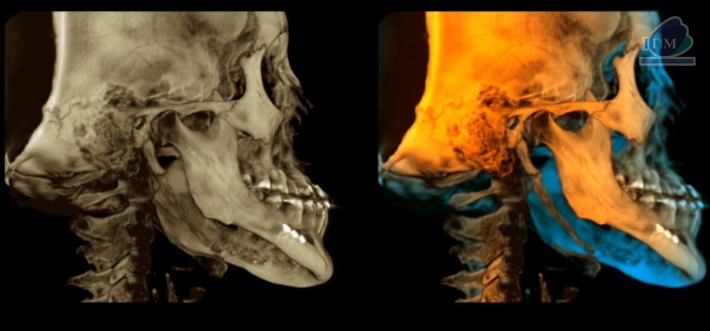 Caso 298 – IDM RECONSTRUCCION 3D - IDM