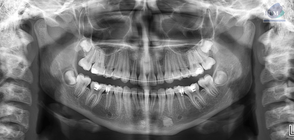 Caso 299 – IDM RADIOGRAFIA PANORAMICA IDM