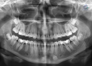 Caso 299 – IDM RADIOGRAFIA PANORAMICA IDM 2