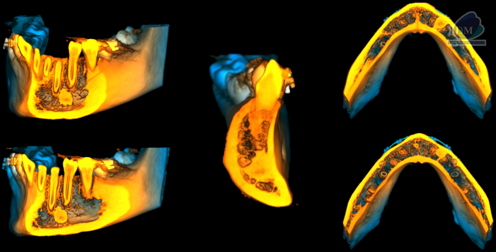 Caso 299 – IDM RECONSTRUCCION 3D - IDM