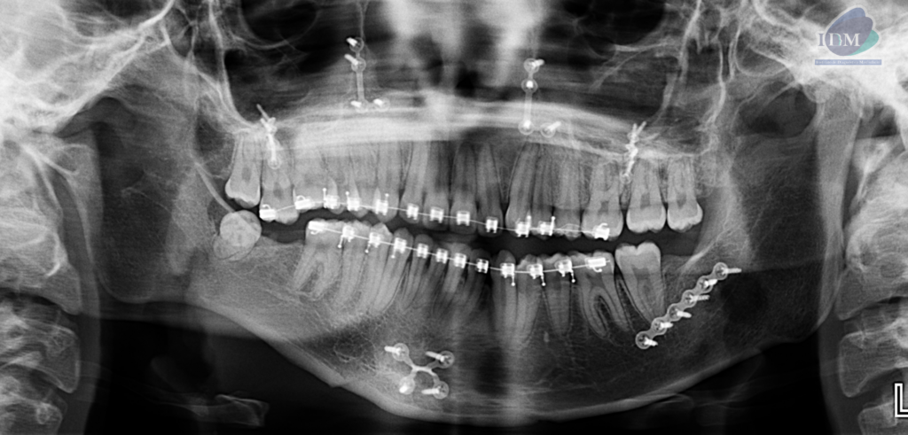 Caso 300 – IDM RADIOGRAFIA PANORAMICA IDM