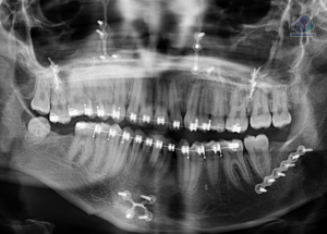 Caso 300 – IDM RADIOGRAFIA PANORAMICA IDM 2
