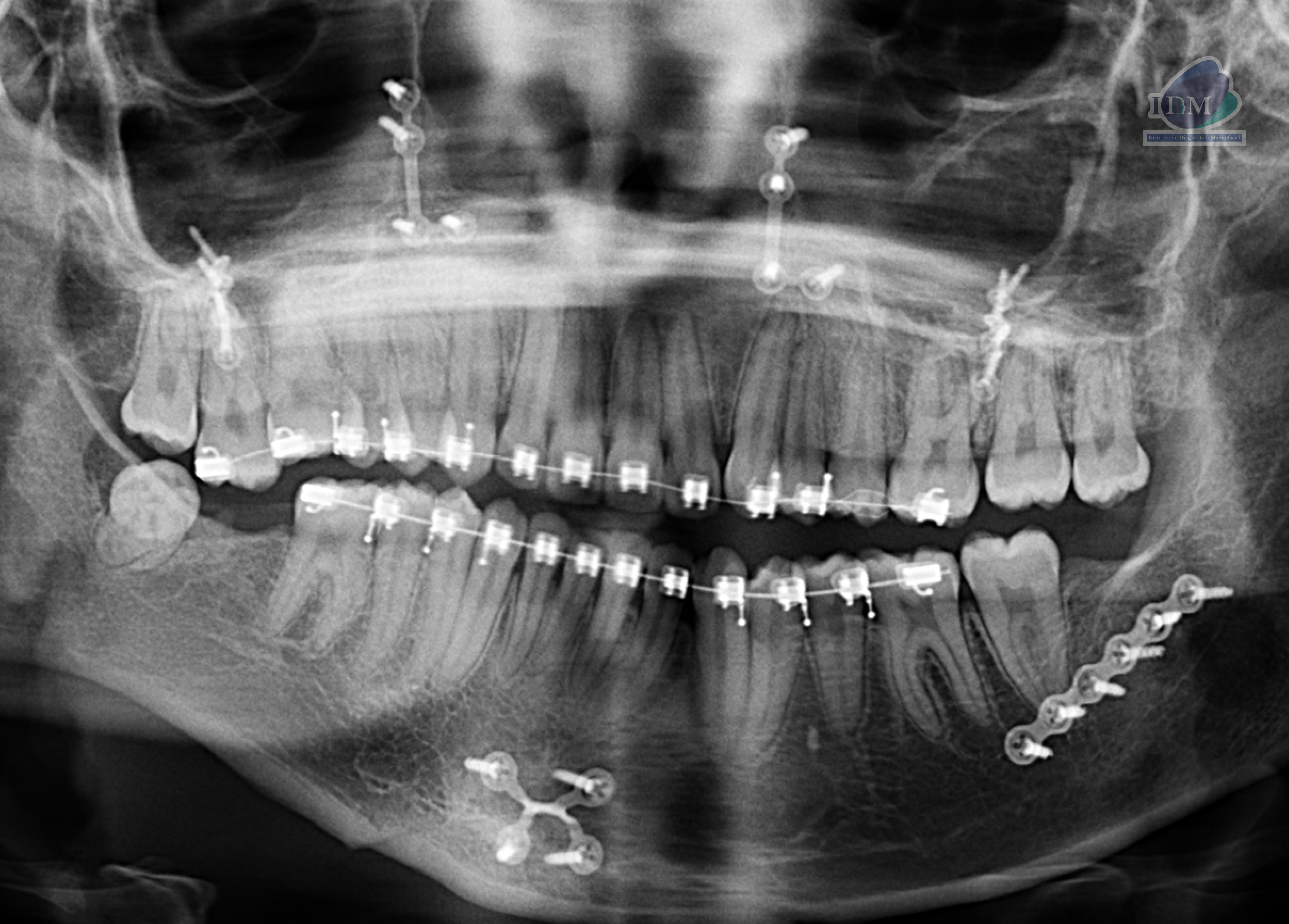 Caso 300 – IDM RADIOGRAFIA PANORAMICA IDM 2