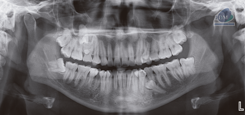 caso 301 - radiografia panoramica IDM 02