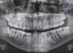 caso 301 - radiografia panoramica IDM