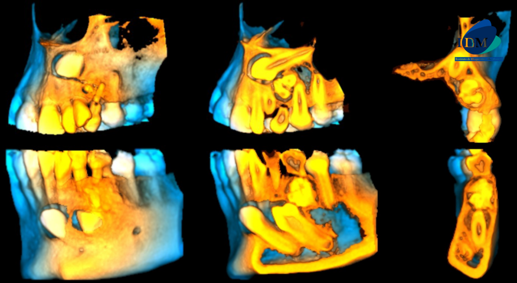 CASO 305 IDM RECONSTRUCCION 3D