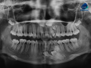 CASO 305 IDM radiografia panoramica 01