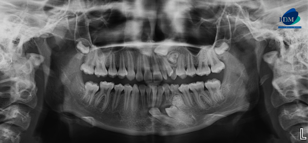 CASO 305 IDM radiografia panoramica 02