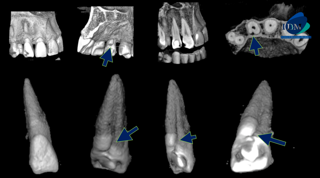 CASO 306 IDM - RECONSTRUCCION 3D