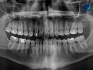 CASO 306 IDM - radiografia panoramica 01
