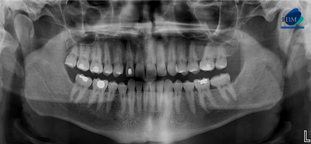 CASO 306 IDM - radiografia panoramica 02