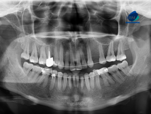 CASO 307 IDM - radiografia panoramica 01