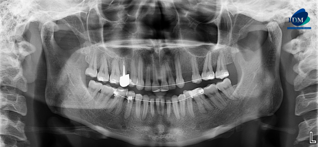 CASO 307 IDM - radiografia panoramica 02
