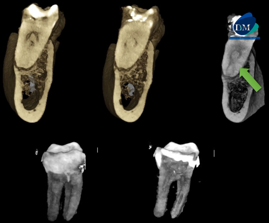 CASO 308 IDM - RECONSTRUCCION 3D