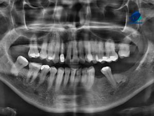 CASO 308 IDM - radiografia panoramica 01