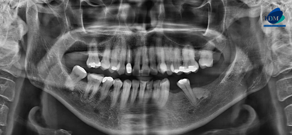 CASO 308 IDM - radiografia panoramica 02