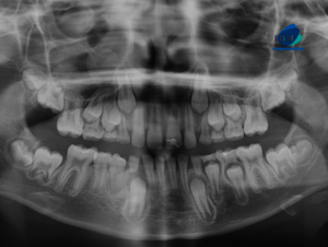 CASO 309 IDM - radiografia panoramica 01
