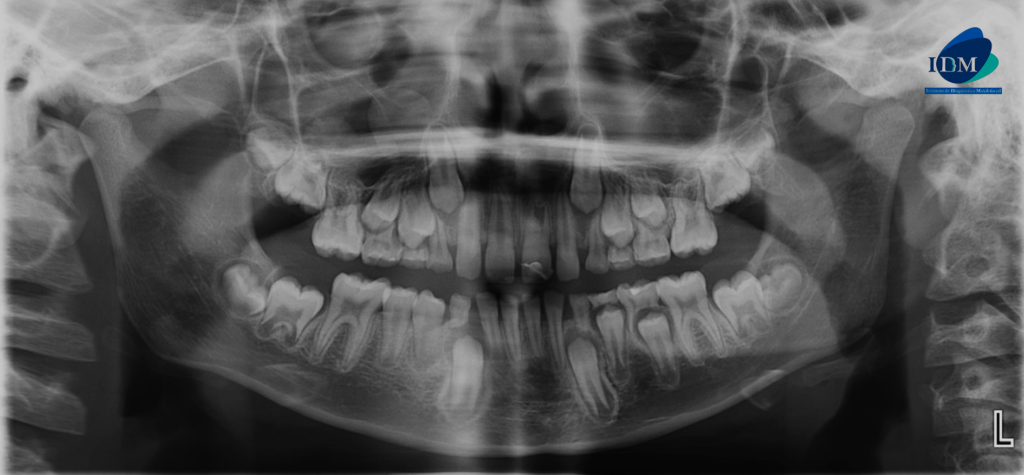 CASO 309 IDM - radiografia panoramica 02