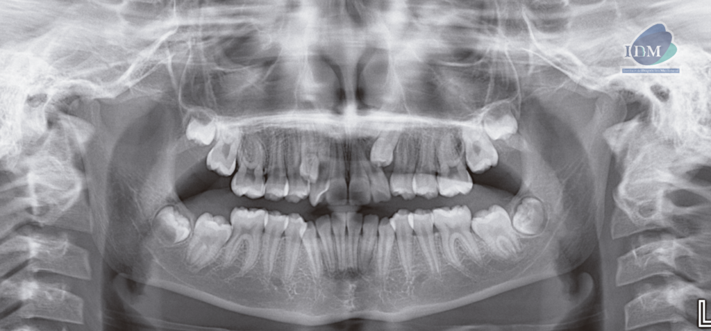 caso 302 - radiografia panoramica 02 IDM