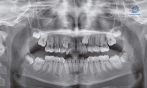 caso 302 - radiografia panoramica IDM