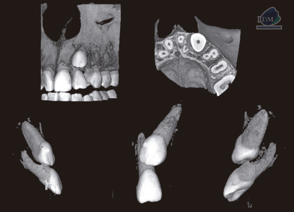 caso 302 - reconstruccion 3D IDM