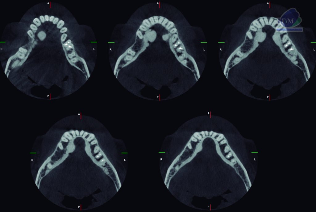 caso 303 - cortes axiales IDM