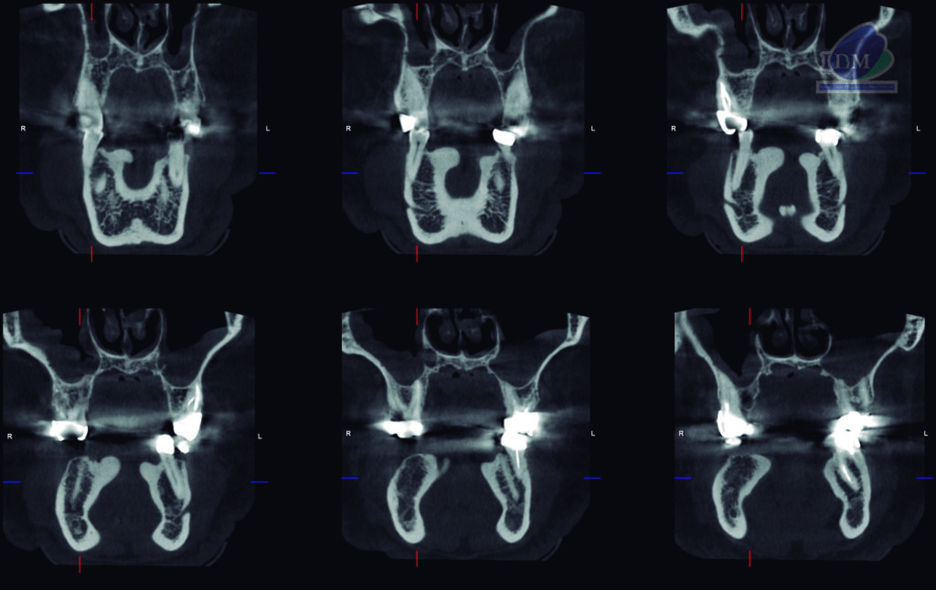 caso 303 - cortes coronales IDM