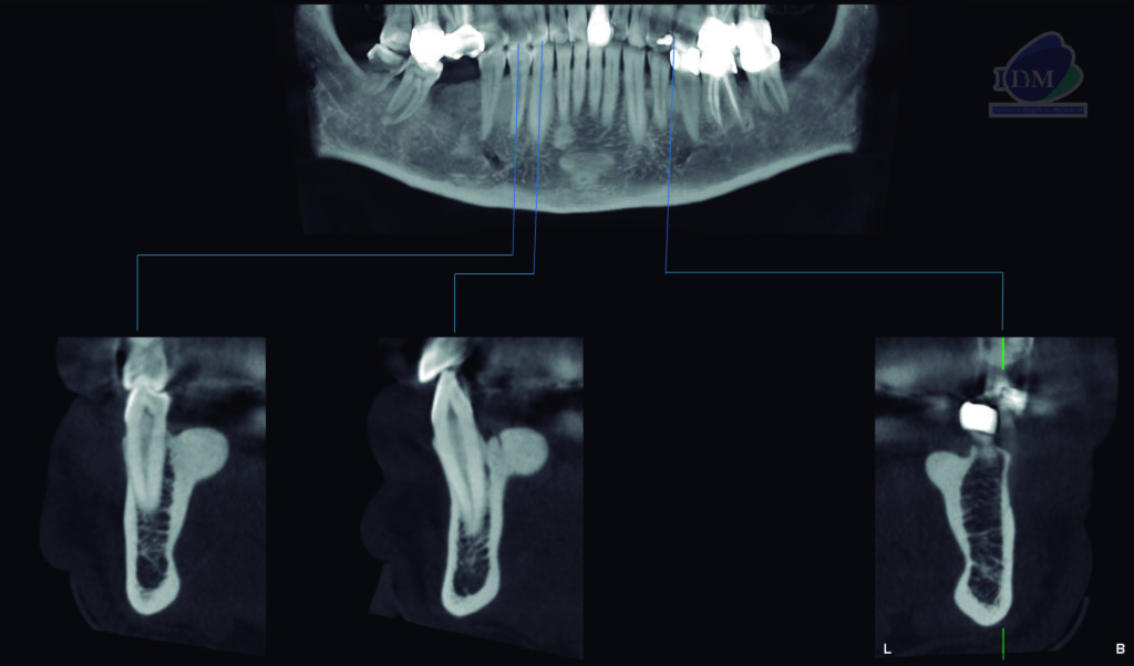 caso 303 - cortes transaxiales IDM