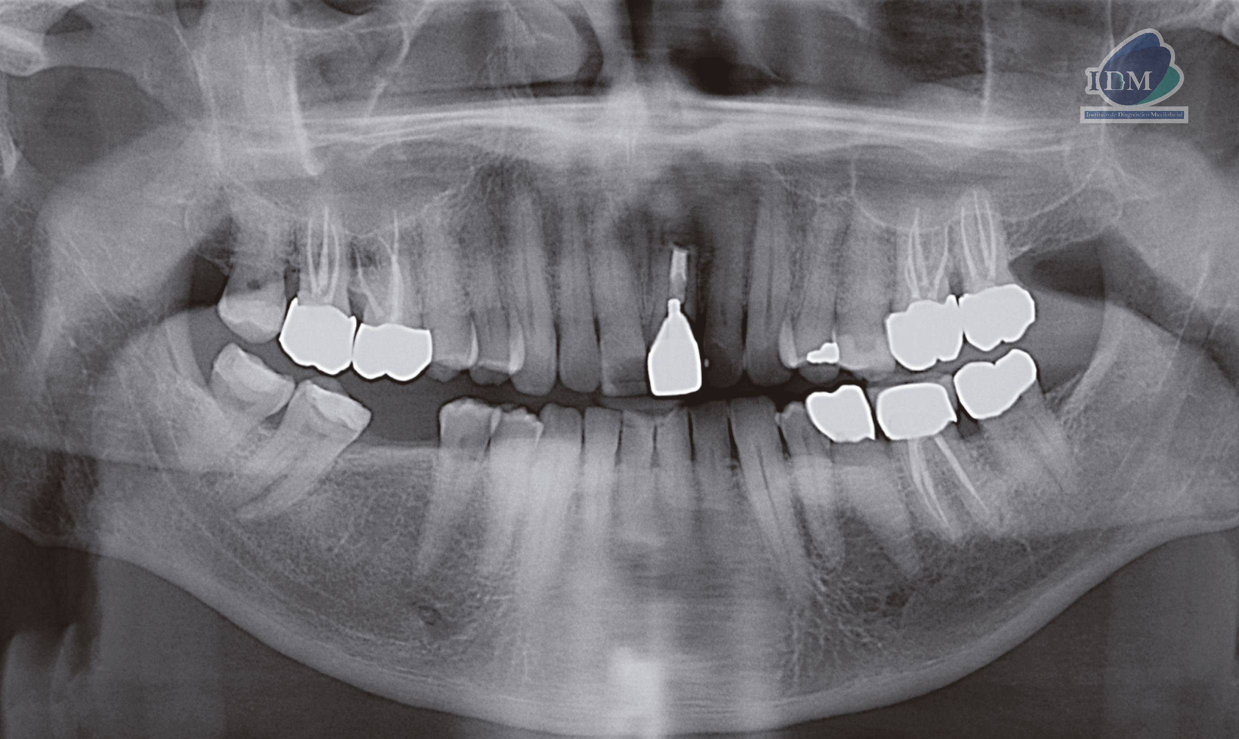 caso 303 - radiografia panoramica IDM