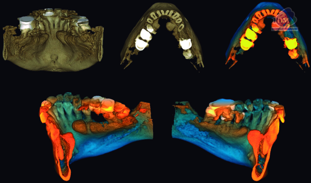 caso 303 - reconstruccion 3D IDM