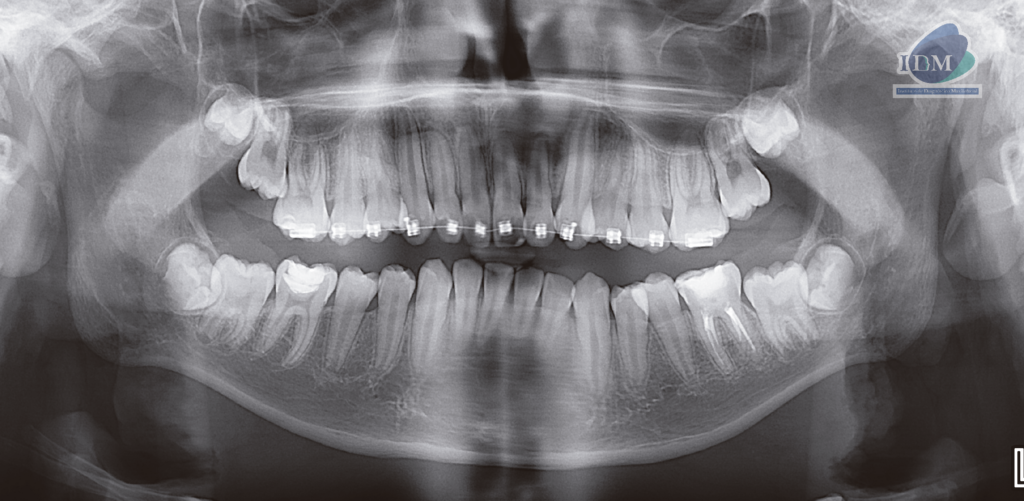 caso 304 - radiografia panoramica 02 IDM