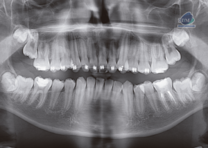 caso 304 - radiografia panoramica IDM
