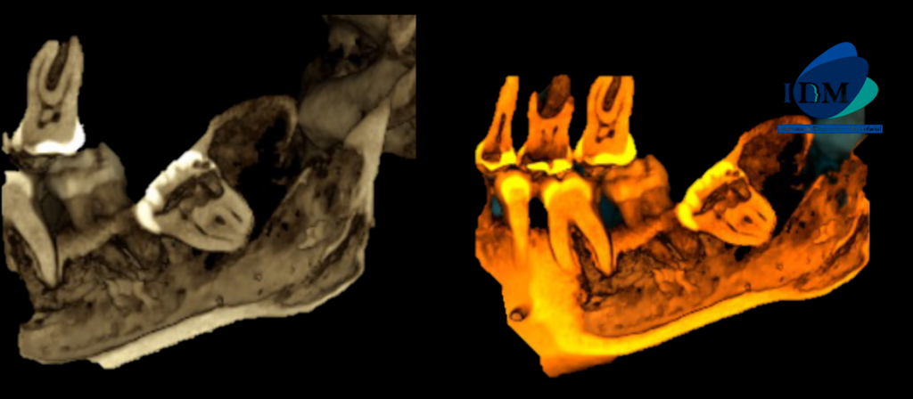 CASO 310 IDM - RECONSTRUCCION 3D