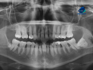 CASO 310 IDM - radiografia panoramica 01