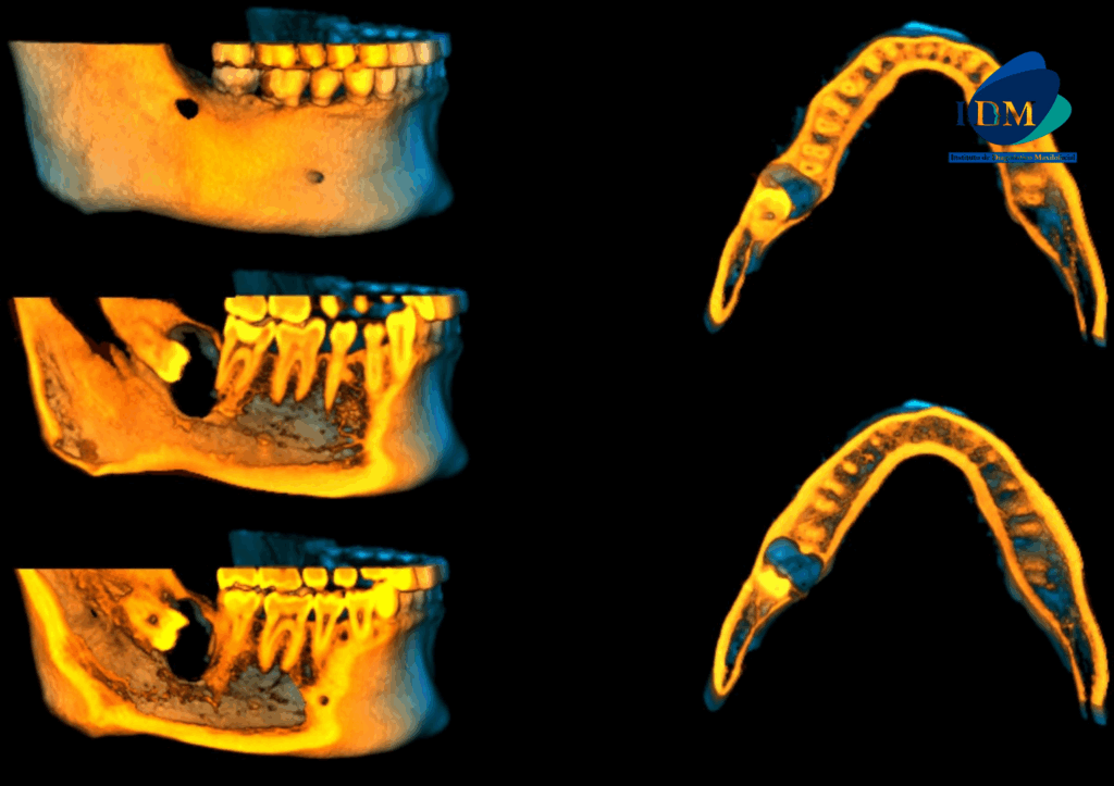 CASO 311 IDM RECONSTRUCCION 3D