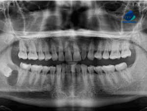CASO 311 IDM radiografia panoramica 01