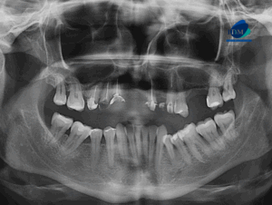 CASO 312 IDM radiografia panoramica 01