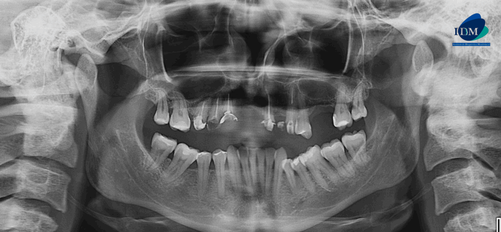 CASO 312 IDM radiografia panoramica 02