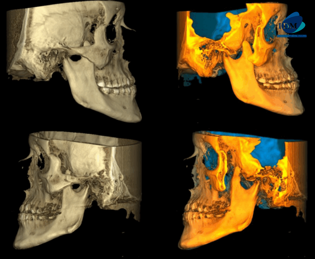 CASO 313 IDM RECONSTRUCCION 3D